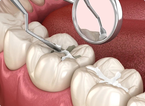 A dentist applying fluoride treatment to a patient’s teeth to prevent cavities and strengthen enamel.