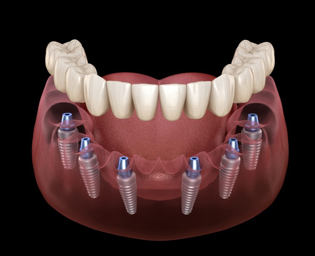 A digital illustration highlighting the importance of gum health in dental implants.