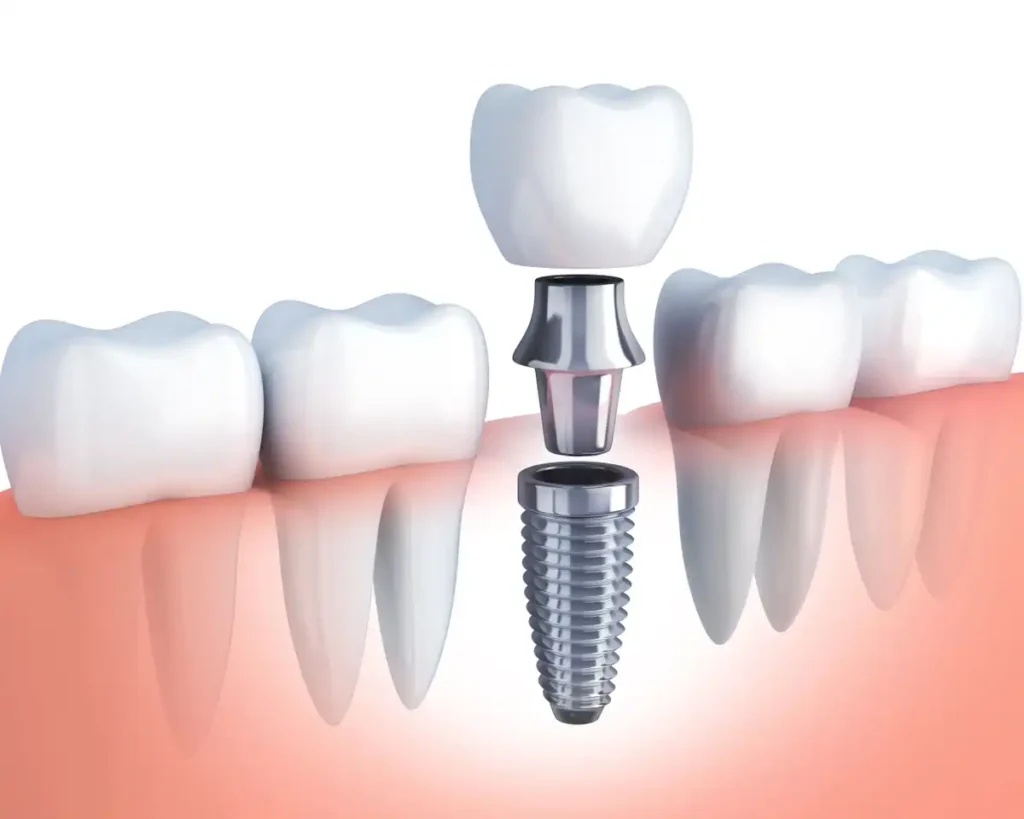 A digital illustration showing a dental implant placed in the jaw with a crown.